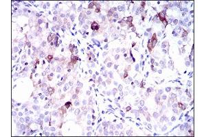 Immunohistochemical analysis of paraffin-embedded cervical cancer tissues using SLC27A5 mouse mAb with DAB staining. (SLC27A5 Antikörper  (AA 508-570))