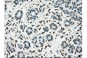 Immunohistochemical staining of paraffin-embedded breast tissue using anti-SSB mouse monoclonal antibody. (SSB Antikörper)