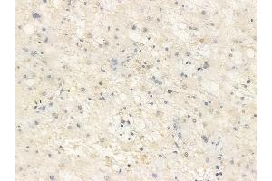 ABIN6255383 and ABIN6267538 at 1/100 staining human astrocytoma by IHC-P.