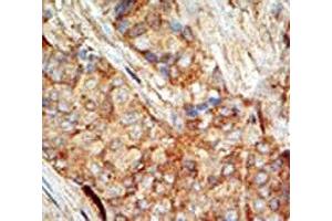 IHC testing of FFPE human breast carcinoma tissue with GCK antibody. (GCK Antikörper  (AA 1-30))