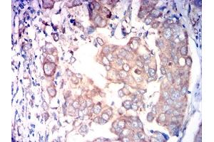 Immunohistochemical analysis of paraffin-embedded breast cancer tissues using FAP mouse mAb with DAB staining. (FAP Antikörper  (AA 26-264))