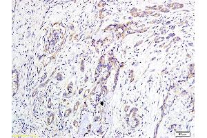 Formalin-fixed and paraffin embedded human pancreatic cancer labeled with Anti-EDG2/LPA1 Polyclonal Antibody, Unconjugated (ABIN681103) at 1:400 followed by conjugation to the secondary antibody and DAB staining (LPAR1 Antikörper  (AA 281-364))