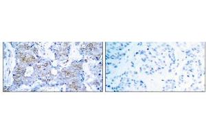 Immunohistochemical analysis of paraffin- embedded human breast carcinoma tissue using HER2 (Ab-1248) antibody (E021072). (ErbB2/Her2 Antikörper)