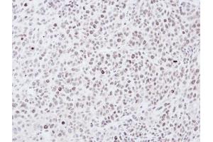 IHC-P Image Immunohistochemical analysis of paraffin-embedded SCM-1 xenograft, using Chk1, antibody at 1:100 dilution. (CHEK1 Antikörper)