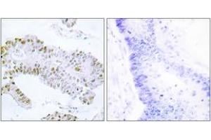 Immunohistochemistry analysis of paraffin-embedded human colon carcinoma tissue, using ERF (Ab-526) Antibody.