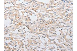 The image on the left is immunohistochemistry of paraffin-embedded Human thyroid cancer tissue using ABIN7131038(SERPINE2 Antibody) at dilution 1/20, on the right is treated with fusion protein. (SERPINE2 Antikörper)