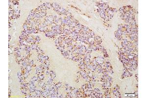 Formalin-fixed and paraffin embedded human thyroid cancer labeled with Anti-IL-21 Polyclonal Antibody, Unconjugated (ABIN748133) at 1:200 followed by conjugation to the secondary antibody and DAB staining (IL-21 Antikörper  (AA 65-155))