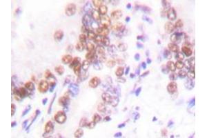 Immunohistochemistry analysis with EP300 / P300 antibody in paraffin-embedded human lung carcinoma tissue. (p300 Antikörper)