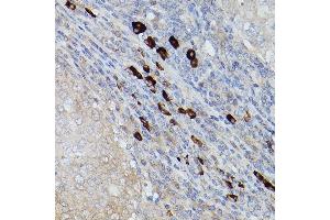 Immunohistochemistry of paraffin-embedded human breast cancer using UBE2L6 Rabbit pAb (ABIN1683197, ABIN3018773, ABIN3018774 and ABIN7101658) at dilution of 1:250 (40x lens). (UBE2L6 Antikörper)