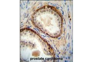 NUDT8 antibody immunohistochemistry analysis in formalin fixed and paraffin embedded human prostate carcinoma followed by peroxidase conjugation of the secondary antibody and DAB staining. (NUDT8 Antikörper  (N-Term))