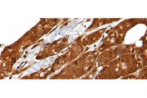 Immunohistochemistry of paraffin-embedded Human breast cancer tissue using LIPG Polyclonal Antibody at dilution of 1:50(x200) (LIPG Antikörper)