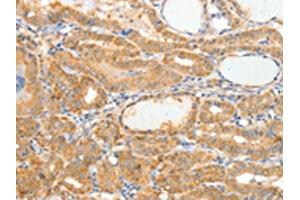 The image on the left is immunohistochemistry of paraffin-embedded Human thyroid cancer tissue using ABIN7189848(APOB Antibody) at dilution 1/10, on the right is treated with synthetic peptide. (APOB Antikörper)