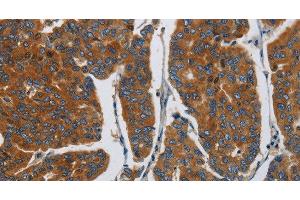 Immunohistochemistry of paraffin-embedded Human breast cancer using APEH Polyclonal Antibody at dilution of 1:30 (APEH Antikörper)