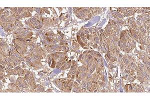 ABIN6268679 at 1/100 staining Human Melanoma tissue by IHC-P. (IL12A Antikörper  (Internal Region))