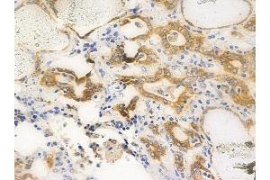 ABIN6256416 and ABIN6267653 at 1/100 staining human thyroid carcinoma by IHC-P. (PKD1/2/3/PKC mu (pSer738), (pSer742) Antikörper)
