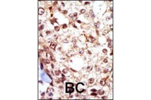 Formalin-fixed and paraffin-embedded human cancer tissue reacted with the primary antibody, which was peroxidase-conjugated to the secondary antibody, followed by AEC staining. (Fgr Antikörper  (N-Term))