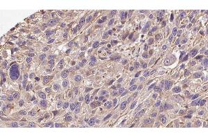 ABIN6272277 at 1/100 staining Human Melanoma tissue by IHC-P. (COL19A1 Antikörper)