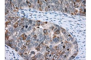 Immunohistochemical staining of paraffin-embedded Adenocarcinoma of Human colon tissue using anti-CD5 mouse monoclonal antibody. (CD5 Antikörper)