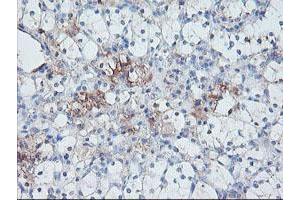 Immunohistochemical staining of paraffin-embedded Carcinoma of Human kidney tissue using anti-SERPINE2 mouse monoclonal antibody. (SERPINE2 Antikörper)