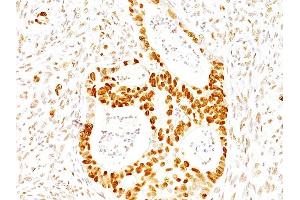 Formalin-fixed, paraffin-embedded human Colon Carcinoma stained with p27 Mouse Monoclonal Antibody (SX53G8). (CDKN1B Antikörper)