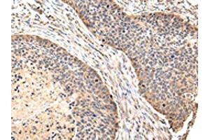 The image on the left is immunohistochemistry of paraffin-embedded Human esophagus cancer tissue using ABIN7128081(VIL1 Antibody) at dilution 1/30, on the right is treated with fusion protein.