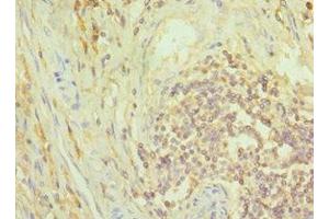 Immunohistochemistry of paraffin-embedded human colon cancer using ABIN7149352 at dilution of 1:100 (NCK1 Antikörper  (AA 58-377))