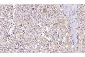 ABIN6273314 at 1/100 staining Human thyroid cancer tissue by IHC-P. (EXOC3 Antikörper  (Internal Region))