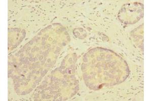 Immunohistochemistry of paraffin-embedded human gastric cancer using ABIN7171988 at dilution of 1:100 (THTPA Antikörper  (AA 2-230))