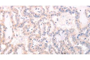 Immunohistochemistry of paraffin-embedded Human thyroid cancer using TRAF3IP1 Polyclonal Antibody at dilution of 1:70