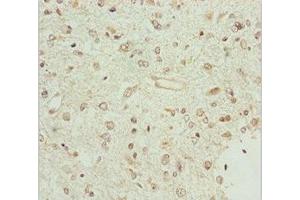 Immunohistochemistry of paraffin-embedded human glioma using ABIN7159847 at dilution of 1:100