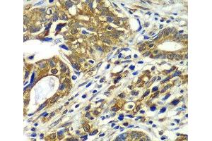 Immunohistochemistry of paraffin-embedded Human gastric cancer using CDC16 Polyclonal Antibody at dilution of 1:100 (40x lens). (CDC16 Antikörper)