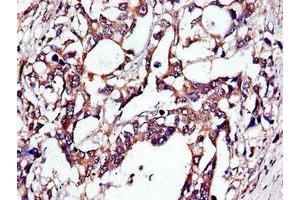 Immunohistochemistry of paraffin-embedded human gastric cancer using ABIN7173671 at dilution of 1:100 (TUBA4A Antikörper  (AA 20-183))