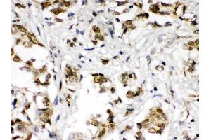 ABR was detected in paraffin-embedded sections of human mammary cancer tissues using rabbit anti- ABR Antigen Affinity purified polyclonal antibody (Catalog # ) at 1 ? (ABR Antikörper  (Middle Region))