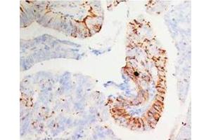 Immunohistochemical analysis of paraffin-embedded mammary cancer sections, staining MORG1 in cytoplasm, DAB staining