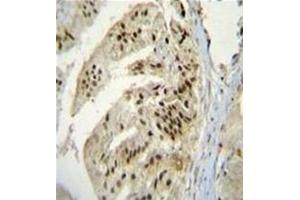 Immunohistochemistry analysis in formalin fixed and paraffin embedded human prostate carcinoma reacted with AP53159PU-N, which was peroxidase conjugated to the secondary antibody and followed by DAB staining. (PAPOLA Antikörper  (Middle Region))