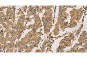 Immunohistochemistry of paraffin-embedded Human breast cancer using DMRT3 Polyclonal Antibody at dilution of 1:50 (DMRT3 Antikörper)
