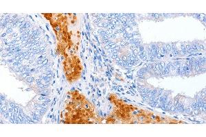Immunohistochemistry of paraffin-embedded Human cervical cancer using ENPP7 Polyclonal Antibody at dilution of 1:50 (ENPP7 Antikörper)