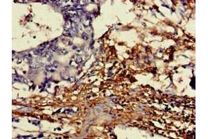 Immunohistochemistry of paraffin-embedded human gastric cancer using ABIN7149454 at dilution of 1:100 (DDO Antikörper  (AA 37-161))