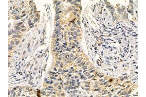 DNALI1 Mouse Monoclonal Antibody at 1/100 staining human lung cancer and adjacent non-tumor tissue by IHC-P. (DNALI1 Antikörper)