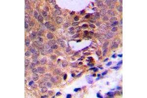 Immunohistochemical analysis of CDC2 (pT161) staining in human breast cancer formalin fixed paraffin embedded tissue section. (CDK1 Antikörper  (pSer161))
