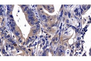 Detection of ITGaV in Human Stomach cancer Tissue using Polyclonal Antibody to Integrin Alpha V (ITGaV) (CD51 Antikörper  (AA 560-744))