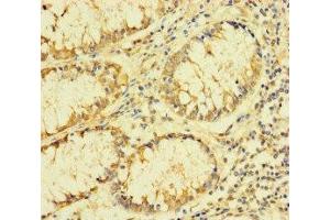 Immunohistochemistry of paraffin-embedded human colon cancer using ABIN7142550 at dilution of 1:100 (FAU Antikörper  (AA 1-59))