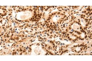 Immunohistochemistry of paraffin-embedded Human gasrtic cancer tissue using E2F7 Polyclonal Antibody at dilution 1:60 (E2F7 Antikörper)