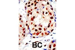 Formalin-fixed and paraffin-embedded human cancer tissue reacted with the primary antibody, which was peroxidase-conjugated to the secondary antibody, followed by DAB staining. (PRMT1 Antikörper  (C-Term))