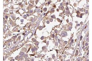 ABIN6267501 at 1/100 staining human breast carcinoma tissue sections by IHC-P.