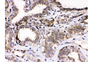 Anti- Parvin alpha Picoband antibody, IHC(P) IHC(P): Human Mammary Cancer Tissue (Parvin alpha Antikörper  (Middle Region))