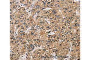 Immunohistochemistry of Human gastric cancer using DDIT4 Polyclonal Antibody at dilution of 1:30 (DDIT4 Antikörper)