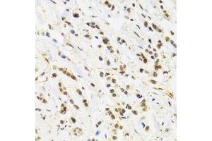 Immunohistochemistry of paraffin-embedded human breast cancer using RAD50 Antibody. (RAD50 Antikörper)
