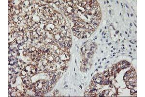 Immunohistochemical staining of paraffin-embedded Adenocarcinoma of Human ovary tissue using anti-PDSS2 mouse monoclonal antibody. (PDSS2 Antikörper)