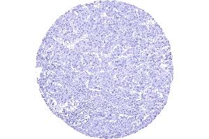 Hepatocellular carcinoma without AGR2 staining of tumor cells (Rekombinanter AGR2 Antikörper)